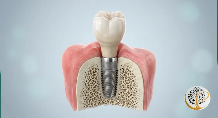 Detailed 3D visualization of a dental implant, abutment, and crown in jawbone.
